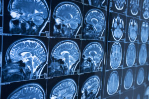 How a Fort Walton Beach Brain Injury Lawyer Can Help You Fight for Damages