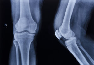 Types of Fractures and Their Hidden Risks