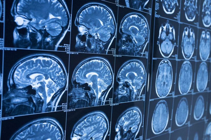 What Is a Closed Head Injury?